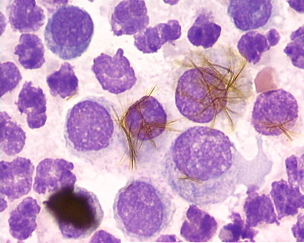 Cytologie d'un lavage broncho-alvéolaire