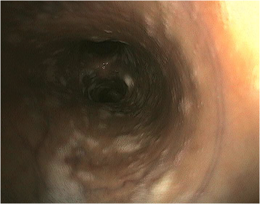 Mucus en quantité augmentée dans la trachée, carina (bifurcation des bronches) très épaisse et diminution du diamètre de la trachée lors d'épisodes de toux (collapse)